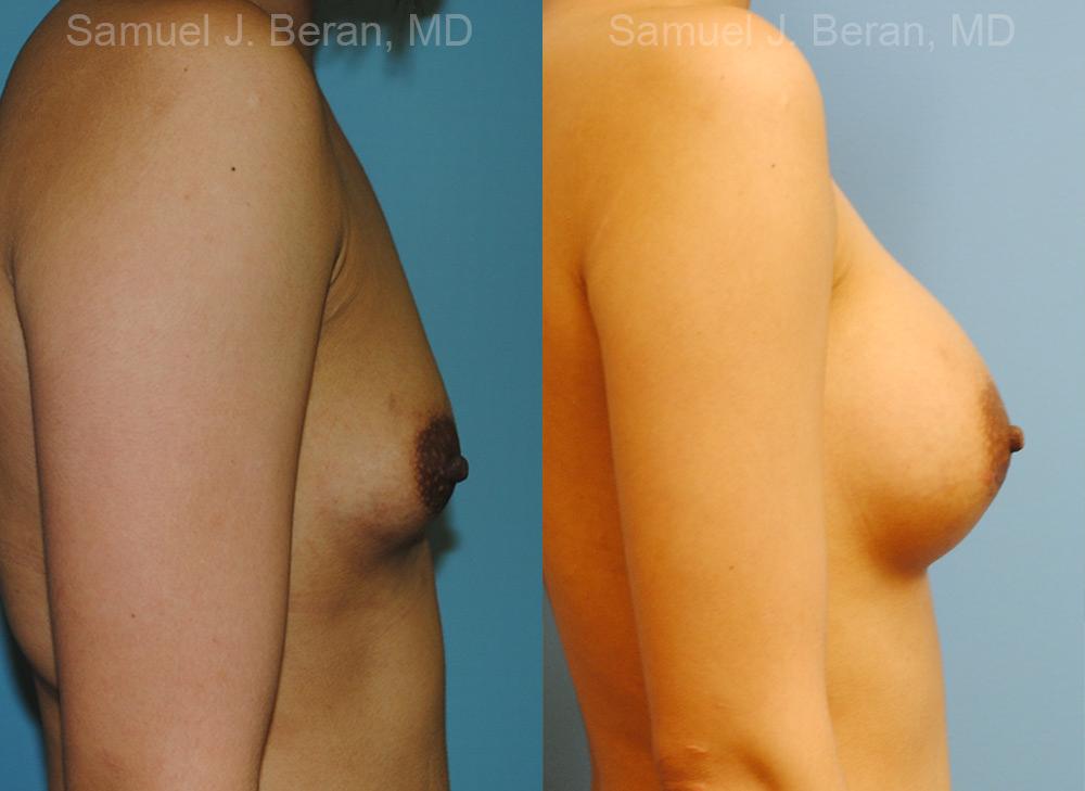 Breast Augmentation Before and After Photos in Montvale, NJ, Patient 12333