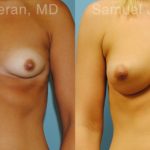 Breast Augmentation Before and After Photos in Montvale, NJ, Patient 12338