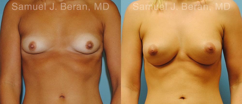Breast Augmentation Before and After Photos in Montvale, NJ, Patient 12338