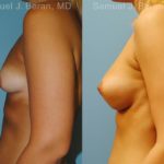 Breast Augmentation Before and After Photos in Montvale, NJ, Patient 12338