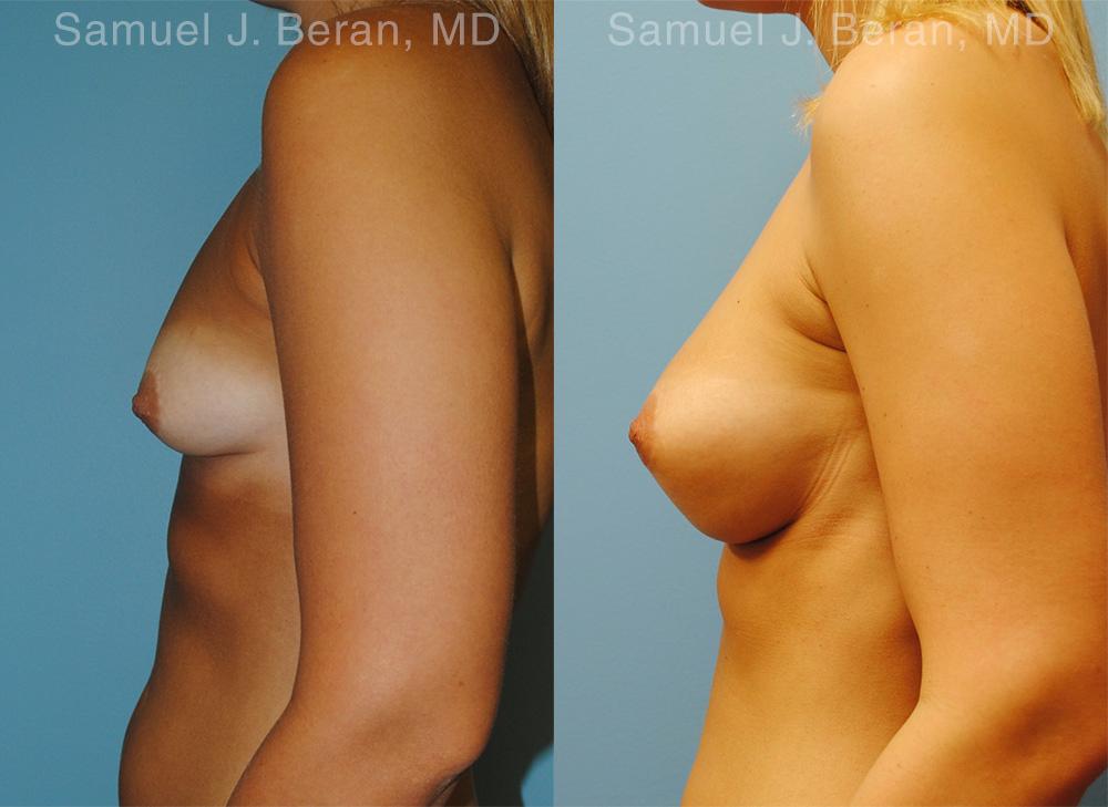 Breast Augmentation Before and After Photos in Montvale, NJ, Patient 12338