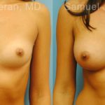 Breast Augmentation Before and After Photos in Montvale, NJ, Patient 12343