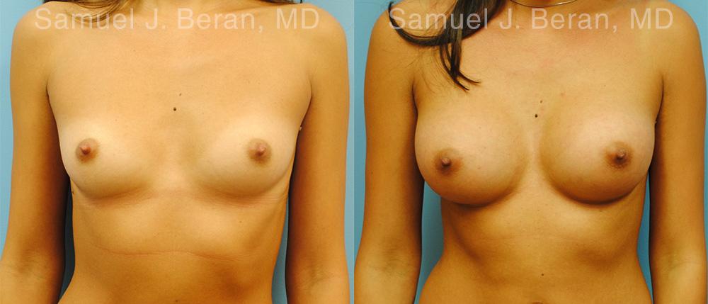 Breast Augmentation Before and After Photos in Montvale, NJ, Patient 12343