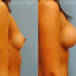 Breast Augmentation Before and After Photos in Montvale, NJ, Patient 12343