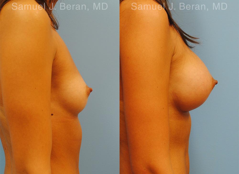 Breast Augmentation Before and After Photos in Montvale, NJ, Patient 12343