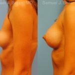 Breast Augmentation Before and After Photos in Montvale, NJ, Patient 12343