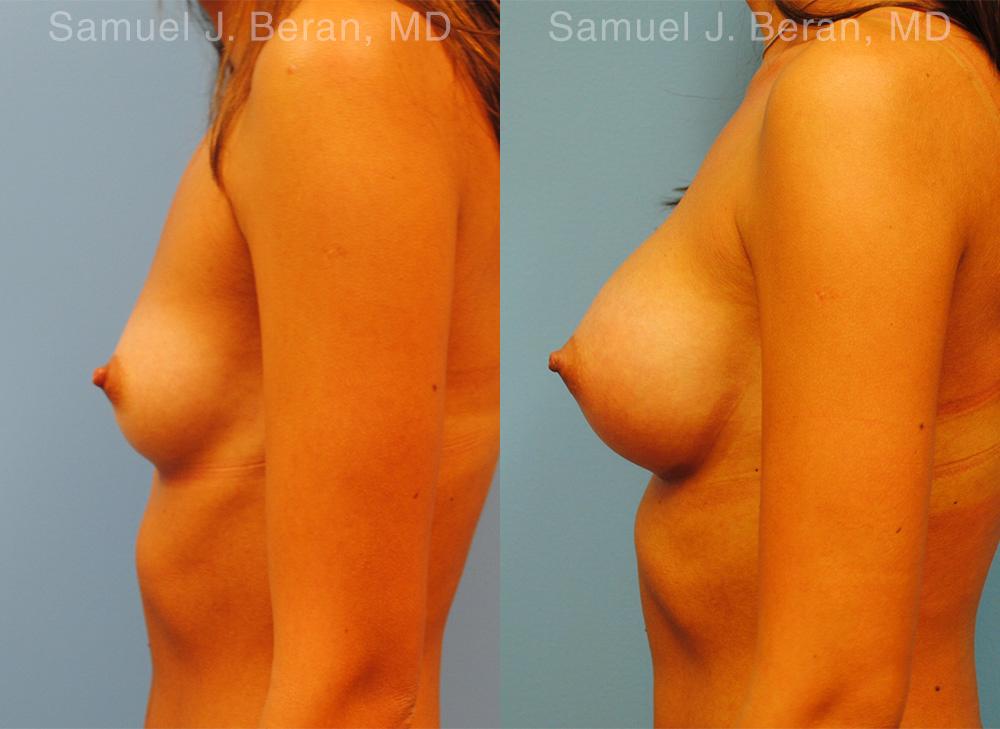 Breast Augmentation Before and After Photos in Montvale, NJ, Patient 12343