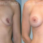 Breast Augmentation Before and After Photos in Montvale, NJ, Patient 12350