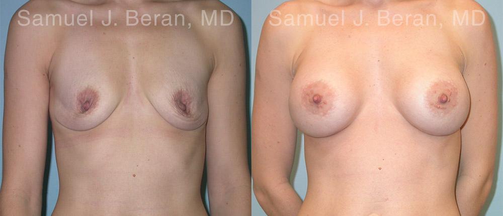 Breast Augmentation Before and After Photos in Montvale, NJ, Patient 12350
