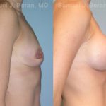 Breast Augmentation Before and After Photos in Montvale, NJ, Patient 12350