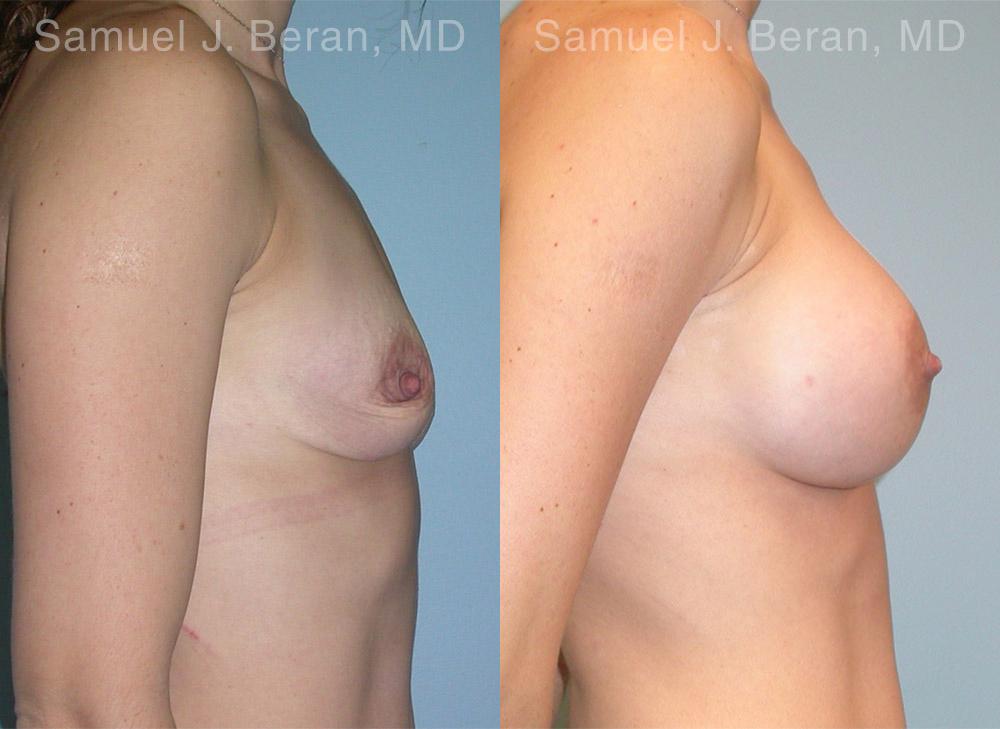 Breast Augmentation Before and After Photos in Montvale, NJ, Patient 12350