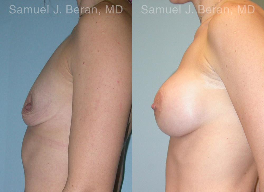 Breast Augmentation Before and After Photos in Montvale, NJ, Patient 12350