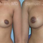 Breast Augmentation Before and After Photos in Montvale, NJ, Patient 12357