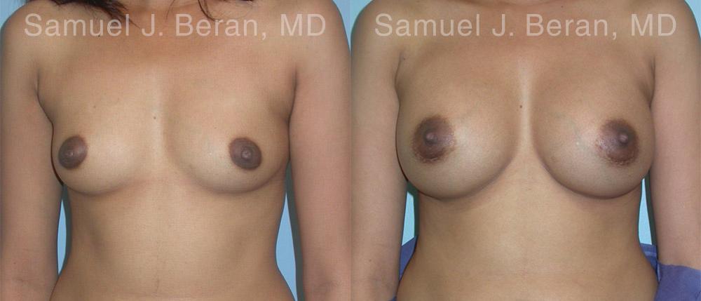Breast Augmentation Before and After Photos in Montvale, NJ, Patient 12357