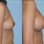 Breast Augmentation Before and After Photos in Montvale, NJ, Patient 12357