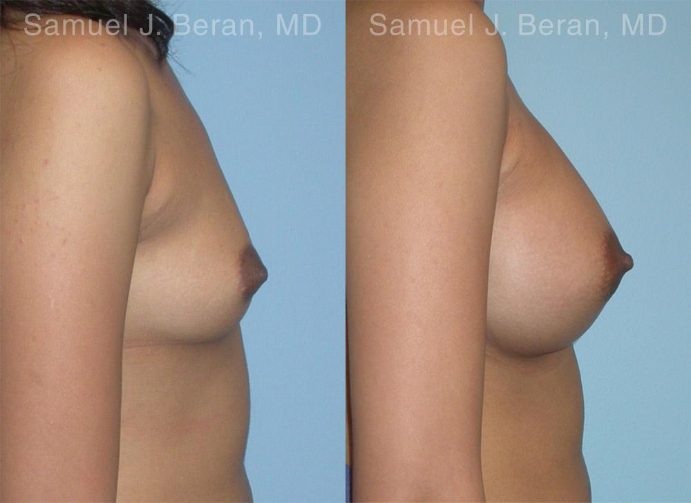 Breast Augmentation Before and After Photos in Montvale, NJ, Patient 12357