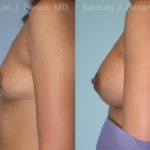 Breast Augmentation Before and After Photos in Montvale, NJ, Patient 12357