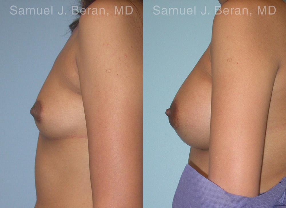 Breast Augmentation Before and After Photos in Montvale, NJ, Patient 12357