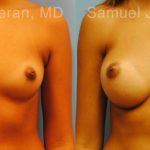 Breast Augmentation Before and After Photos in Montvale, NJ, Patient 12364