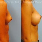Breast Augmentation Before and After Photos in Montvale, NJ, Patient 12364