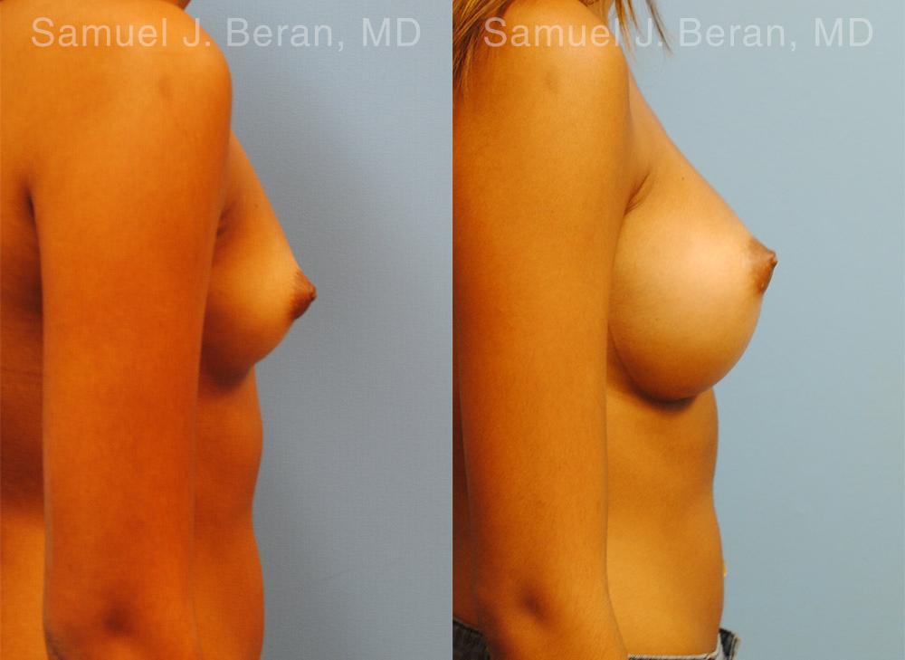 Breast Augmentation Before and After Photos in Montvale, NJ, Patient 12364