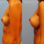 Breast Augmentation Before and After Photos in Montvale, NJ, Patient 12364