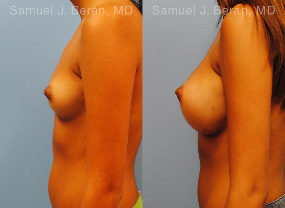 Breast Augmentation Before and After Photos in Montvale, NJ, Patient 12364