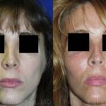 Cheek Augmentation Before and After Photos in Montvale, NJ, Patient 12371