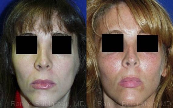 Cheek Augmentation Before and After Photos in Montvale, NJ, Patient 12371