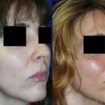 Cheek Augmentation Before and After Photos in Montvale, NJ, Patient 12371