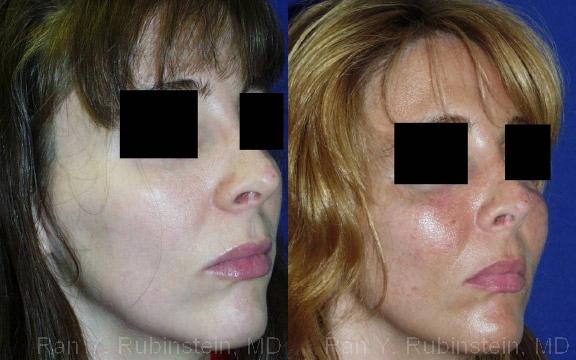 Cheek Augmentation Before and After Photos in Montvale, NJ, Patient 12371