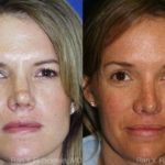 Brow Lift Before and After Photos in Montvale, NJ, Patient 12495