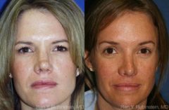 Brow Lift Before and After Photos in Montvale, NJ, Patient 12495