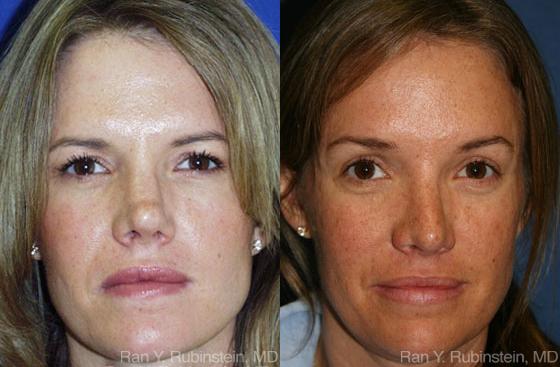 Brow Lift Before and After Photos in Montvale, NJ, Patient 12495