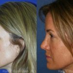 Brow Lift Before and After Photos in Montvale, NJ, Patient 12495
