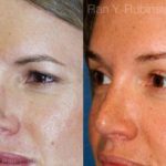 Brow Lift Before and After Photos in Montvale, NJ, Patient 12495