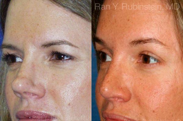 Brow Lift Before and After Photos in Montvale, NJ, Patient 12495