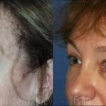 Brow Lift Before and After Photos in Montvale, NJ, Patient 12502