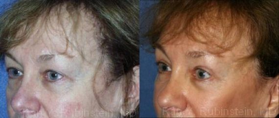 Brow Lift Before and After Photos in Montvale, NJ, Patient 12502