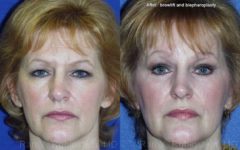 Brow Lift Before and After Photos in Montvale, NJ, Patient 12505