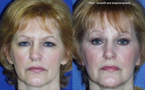 Brow Lift Before and After Photos in Montvale, NJ, Patient 12505
