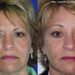 Brow Lift Before and After Photos in Montvale, NJ, Patient 12513