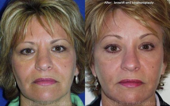 Brow Lift Before and After Photos in Montvale, NJ, Patient 12513