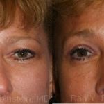 Brow Lift Before and After Photos in Montvale, NJ, Patient 12516