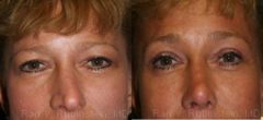 Brow Lift Before and After Photos in Montvale, NJ, Patient 12516
