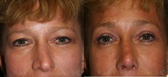 Brow Lift Before and After Photos in Montvale, NJ, Patient 12516