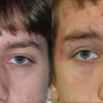 Brow Lift Before and After Photos in Montvale, NJ, Patient 12519