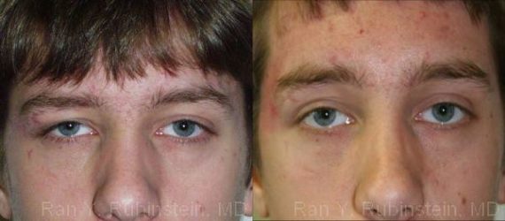 Brow Lift Before and After Photos in Montvale, NJ, Patient 12519