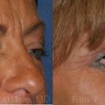 Brow Lift Before and After Photos in Montvale, NJ, Patient 12522