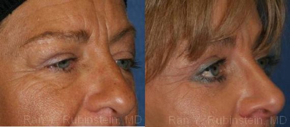 Brow Lift Before and After Photos in Montvale, NJ, Patient 12522